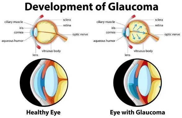 glaucoma diagram