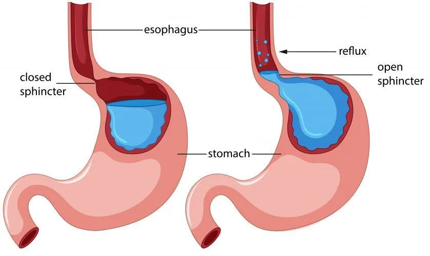 Gastroesophageal Reflux Disease Anatomy