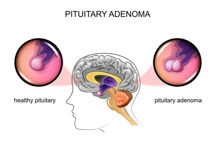 Pituitary adenoma