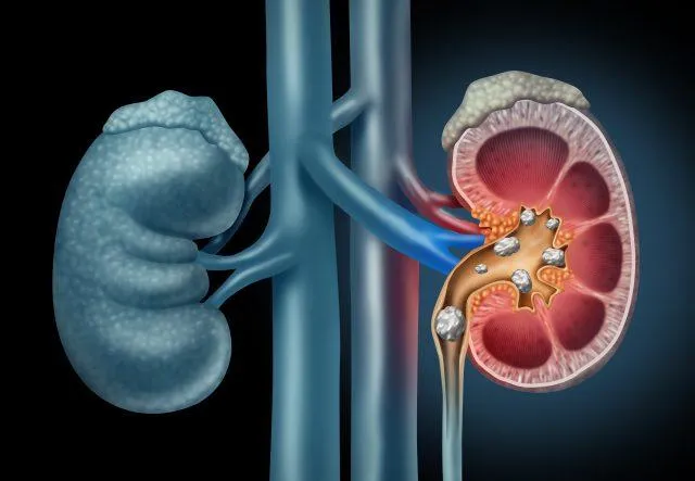 Kidney disease