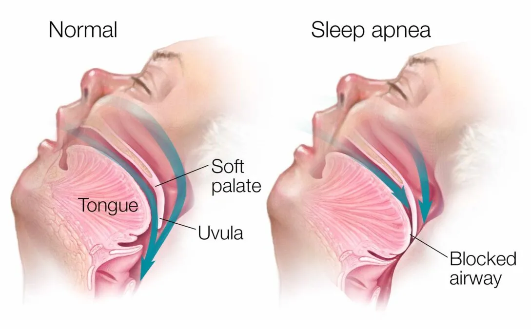 Sleep Apnea 1