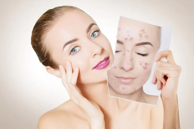 Tips To Deal With Acne 1