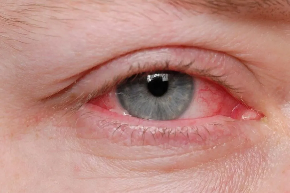 Tom Chang, Md On Dealing With Conjunctivitis