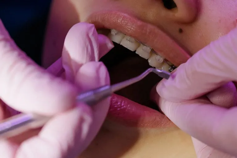 Different Types Of Dental Braces For Your Teeth