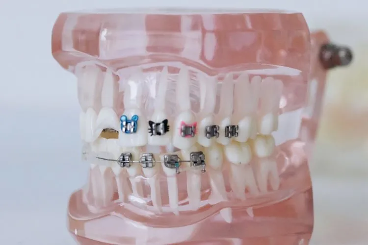 Types Of Dental Braces