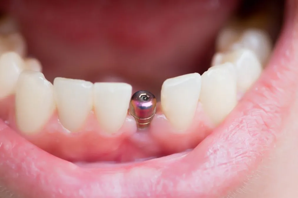 What is a dental implant?