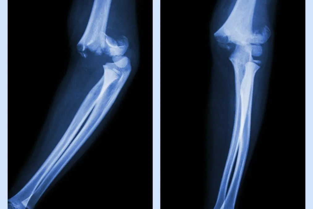 What Does Stress Fracture Feel Like