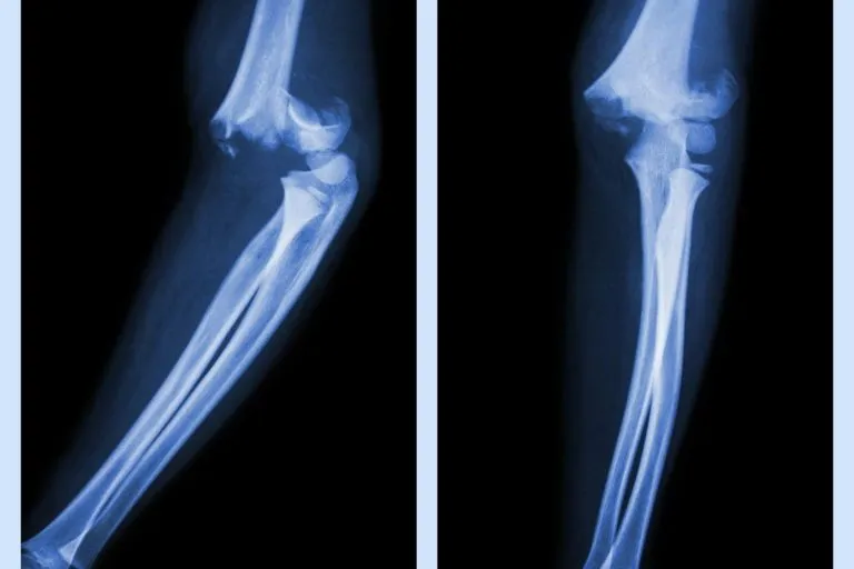 What Does Stress Fracture Feel Like