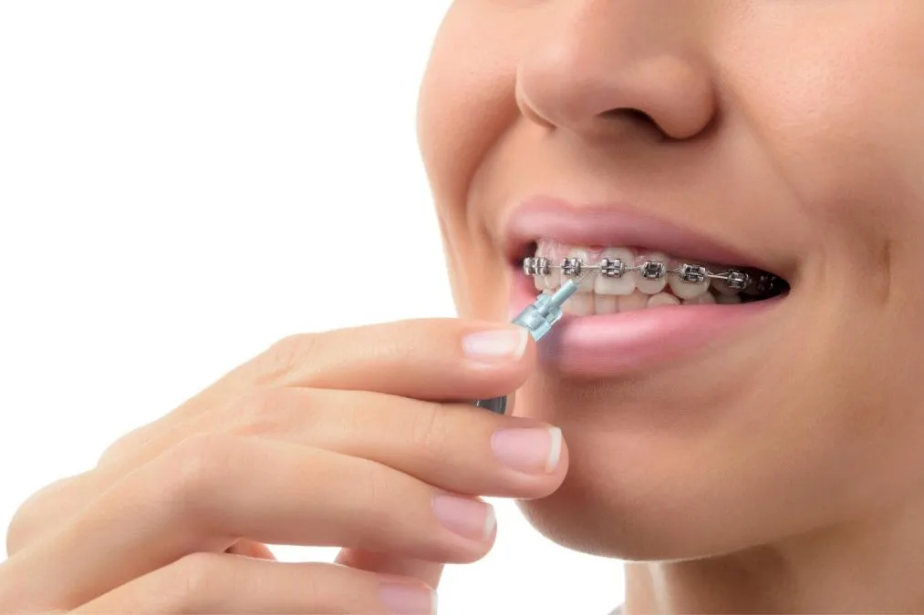 Why Metal Dental Braces Are A Thing Of The Past