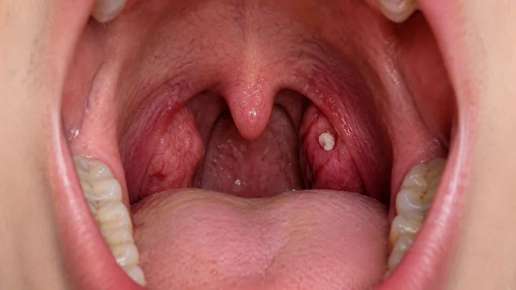 Small pale tonsil stone visible on a tonsil